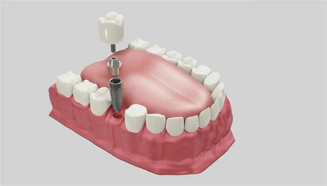 Dental prosthesis